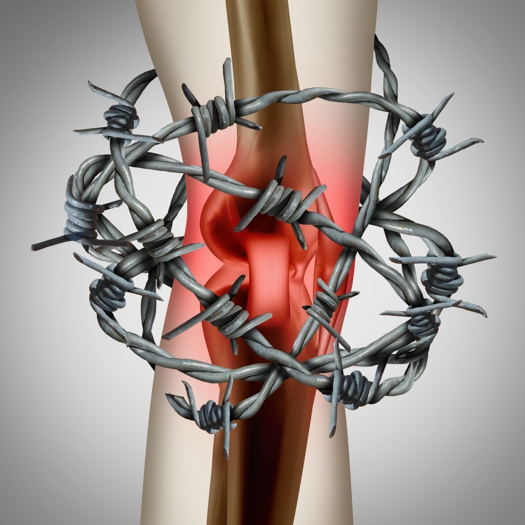 Knee pain and painful joint as a medical illustration of a human skeleton showing a sports injury or a physical accident with barbed wire with 3D illustration elements.