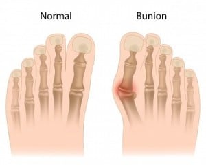 normal-vs-bunion